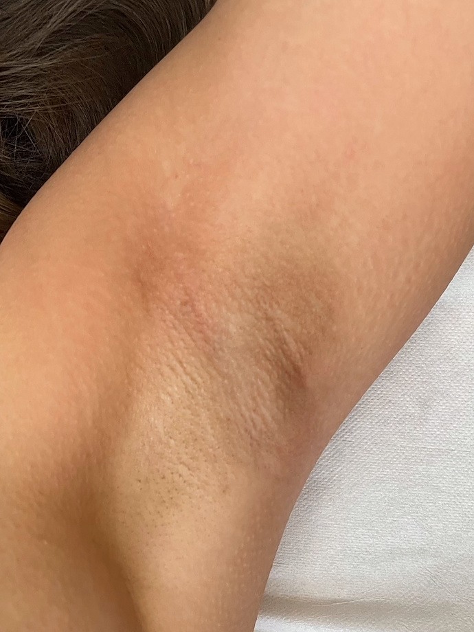 Underarms after intimate bleaching