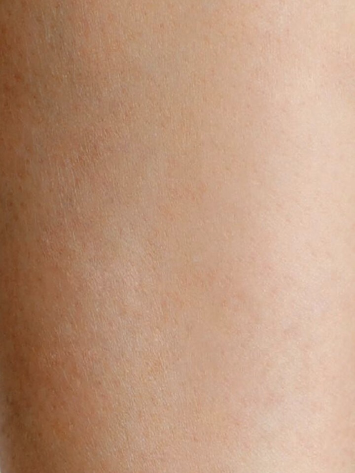 Legs after laser hair removal