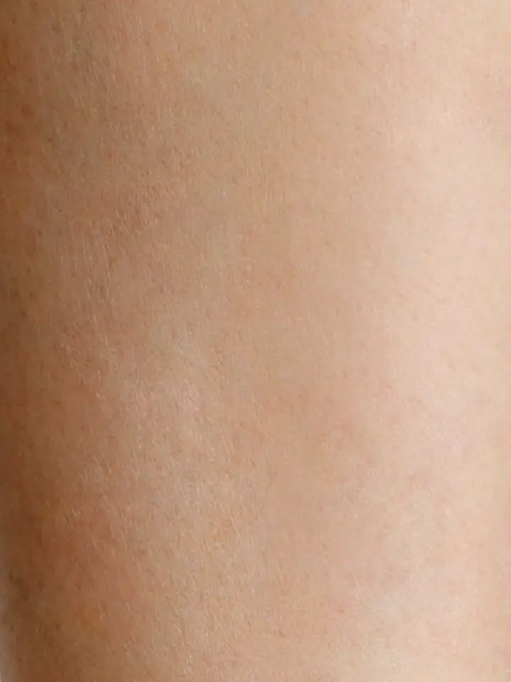 Benen na laser ontharen