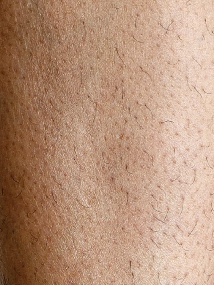 Legs before the treatment