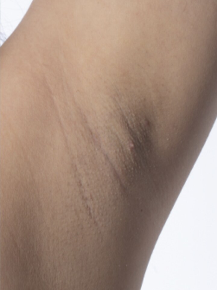 Underarms after laser hair removal
