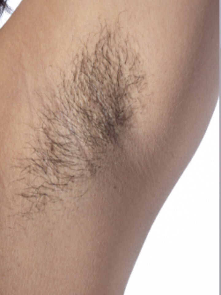 Underarms before the treatment