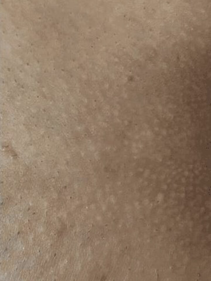 Pubic area after the treatment