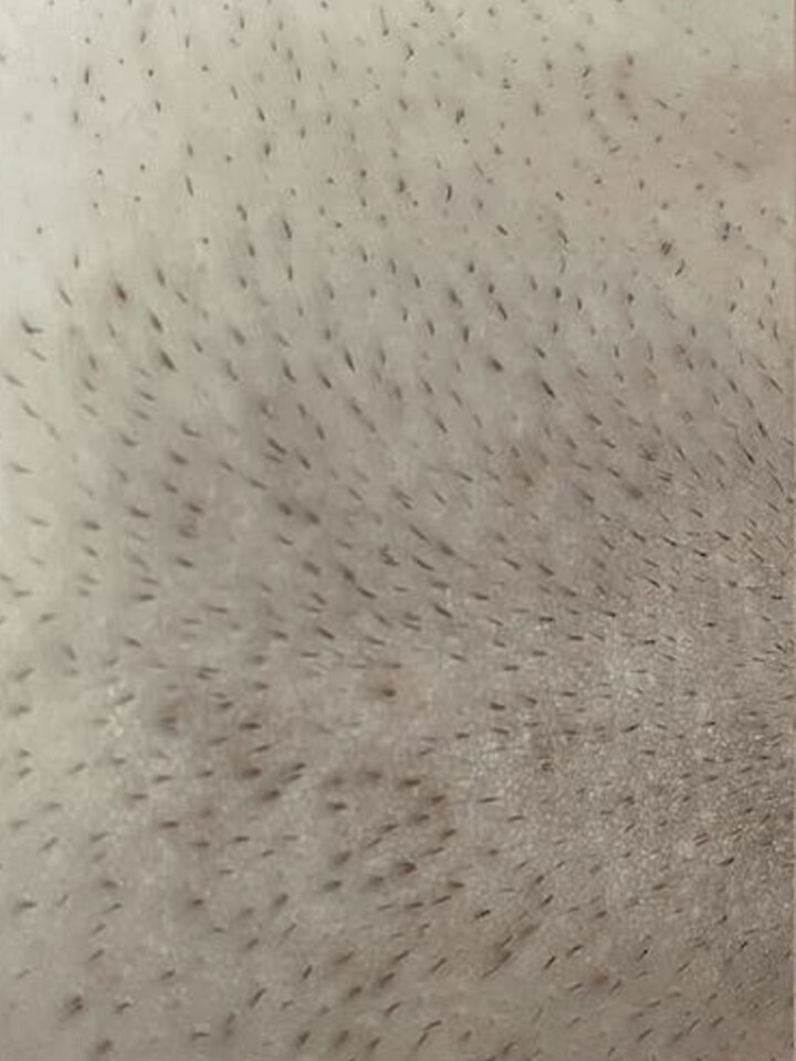 Pubic area before the treatment